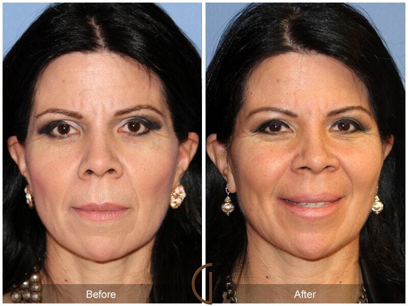 Facial Fat Grafting Before & After Photo