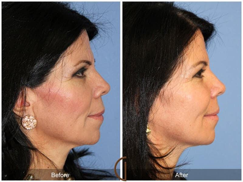 Facial Fat Grafting Before & After Photo