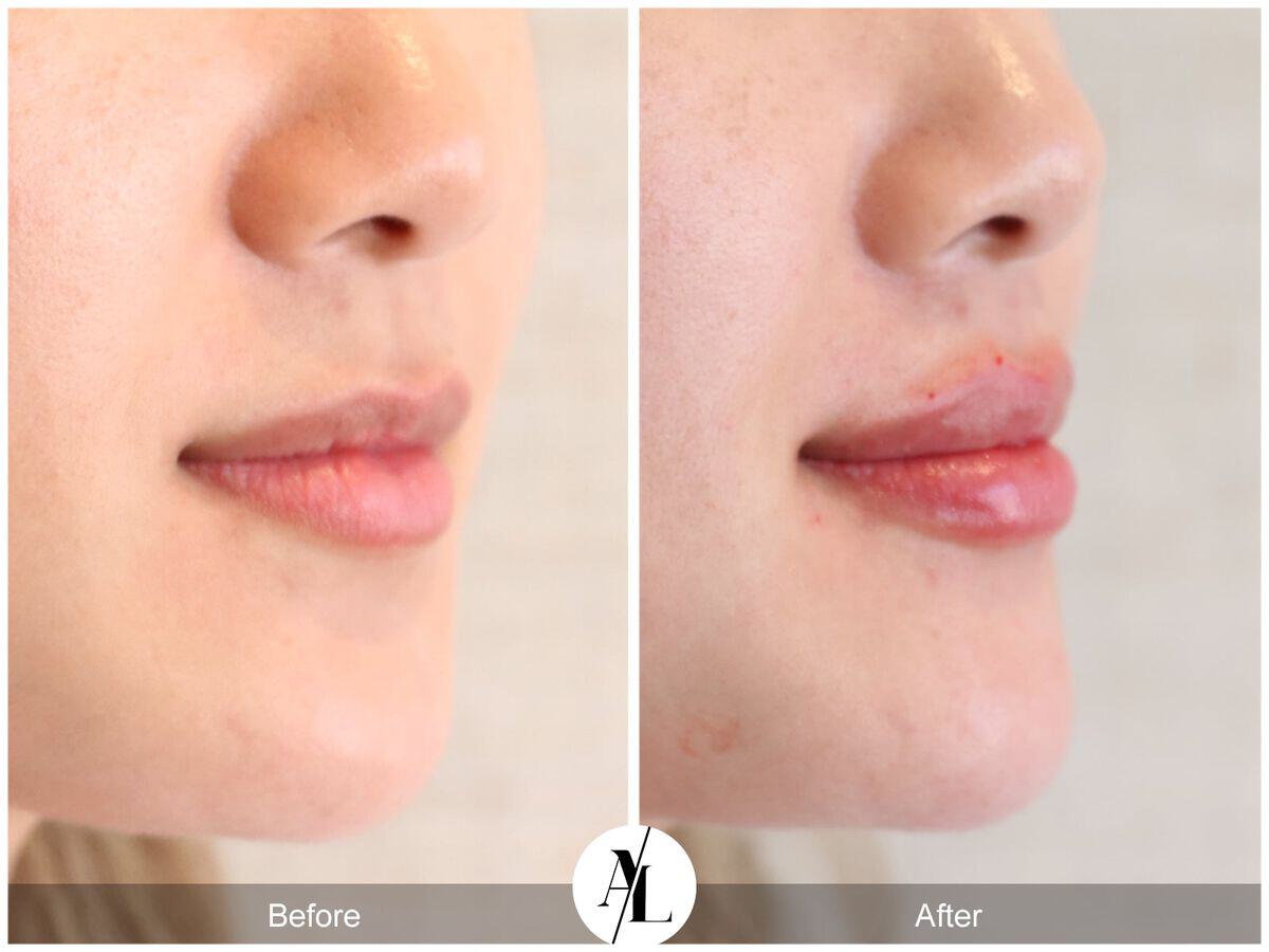 Injectables Before & After Photo