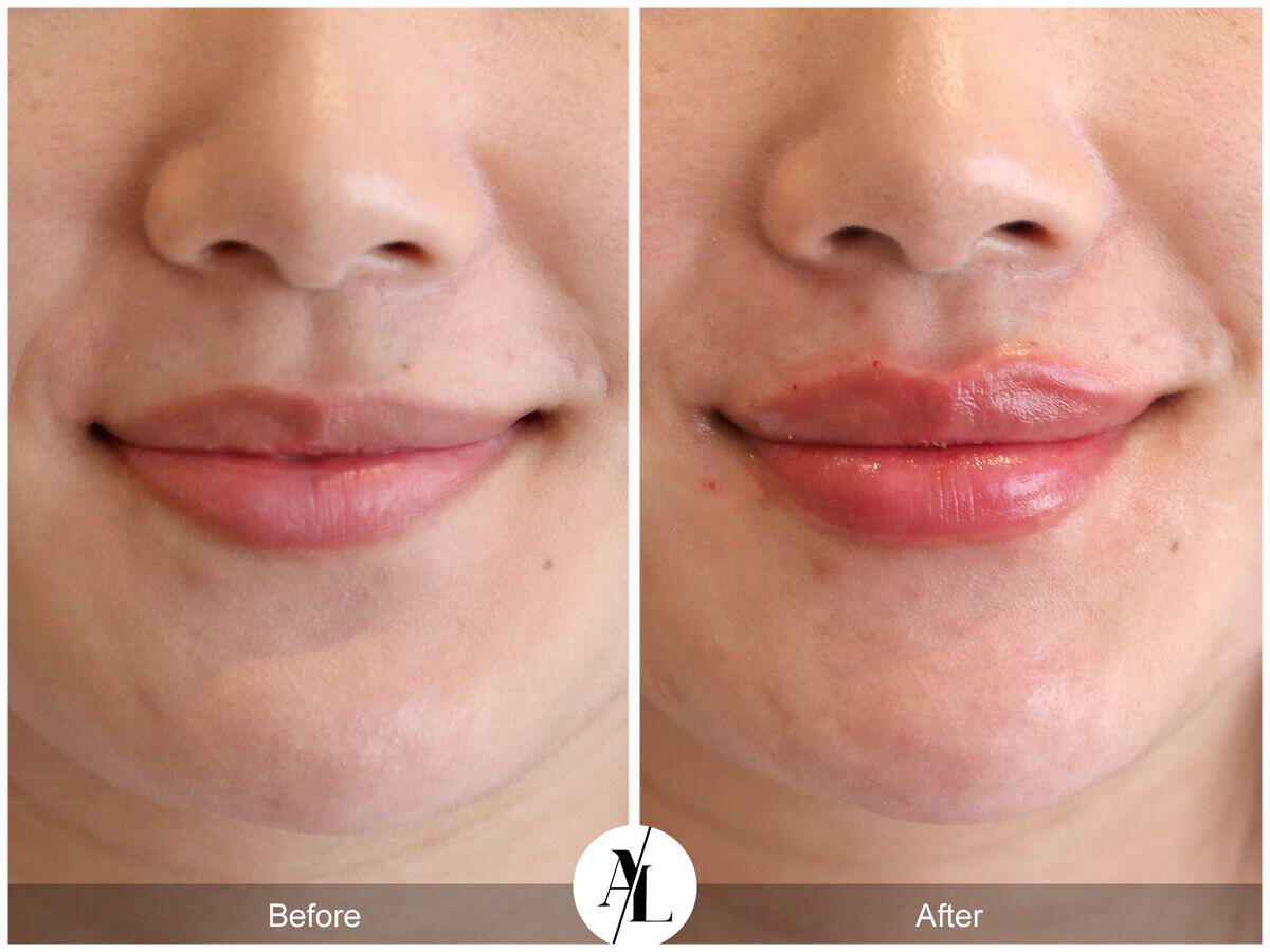 Injectables Before & After Photo