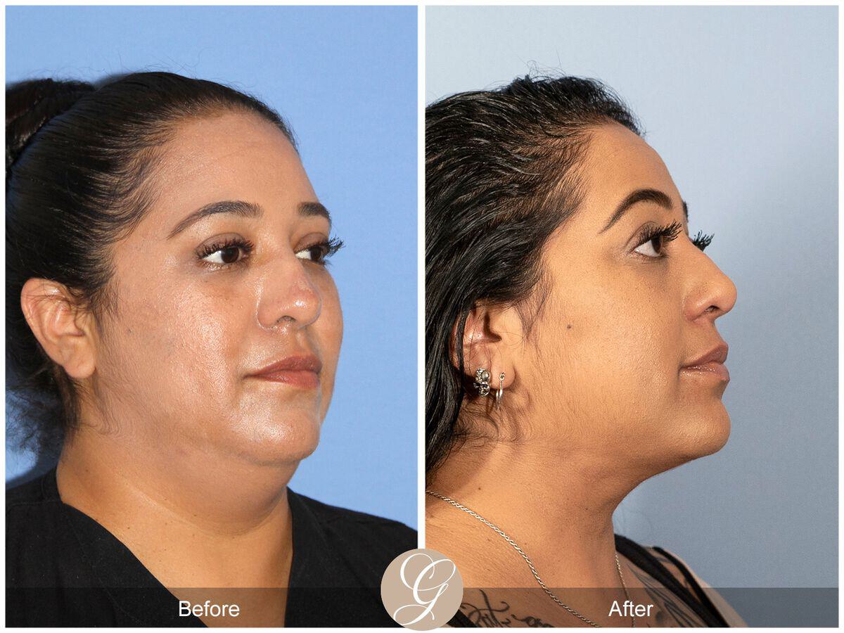 Neck Liposuction Before & After Photo