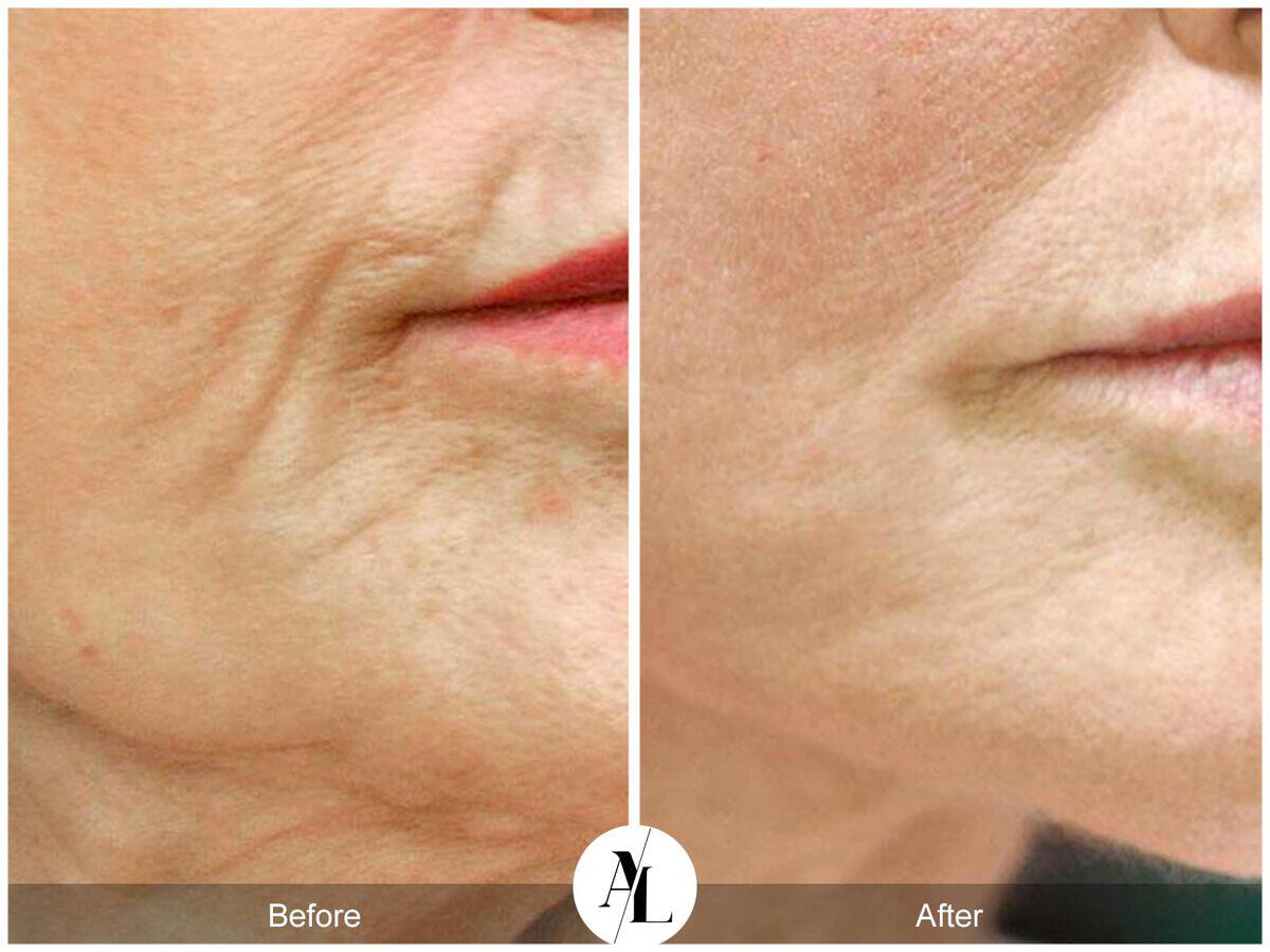 Skin Tightening Before & After Photo