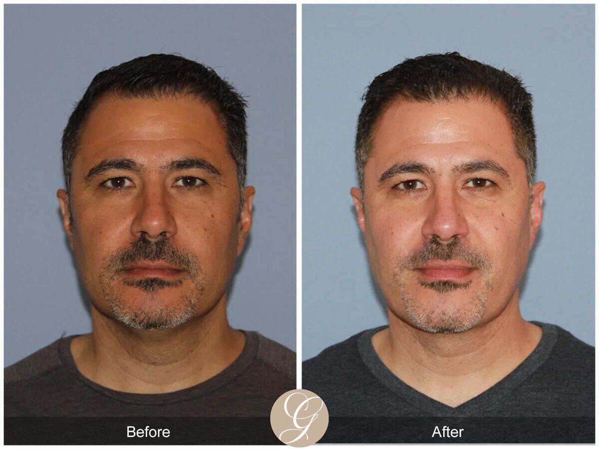 Skin Tightening Before & After Photo