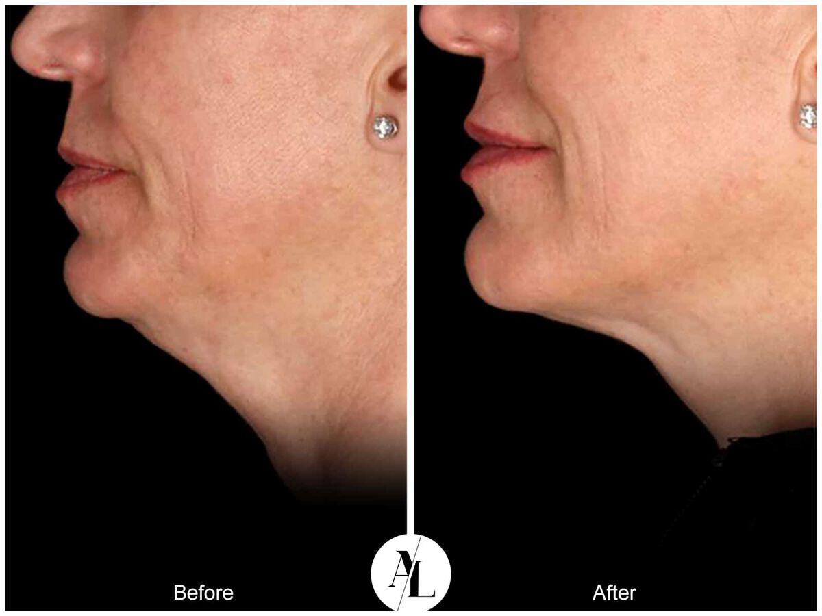 Skin Tightening Before & After Photo