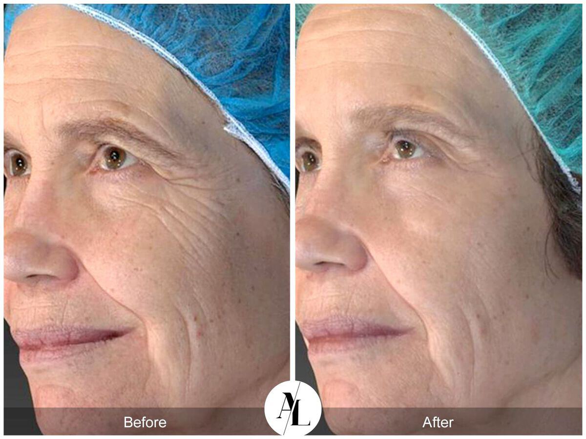 Skin Tightening Before & After Photo