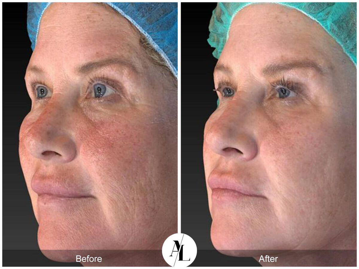 Skin Tightening Before & After Photo