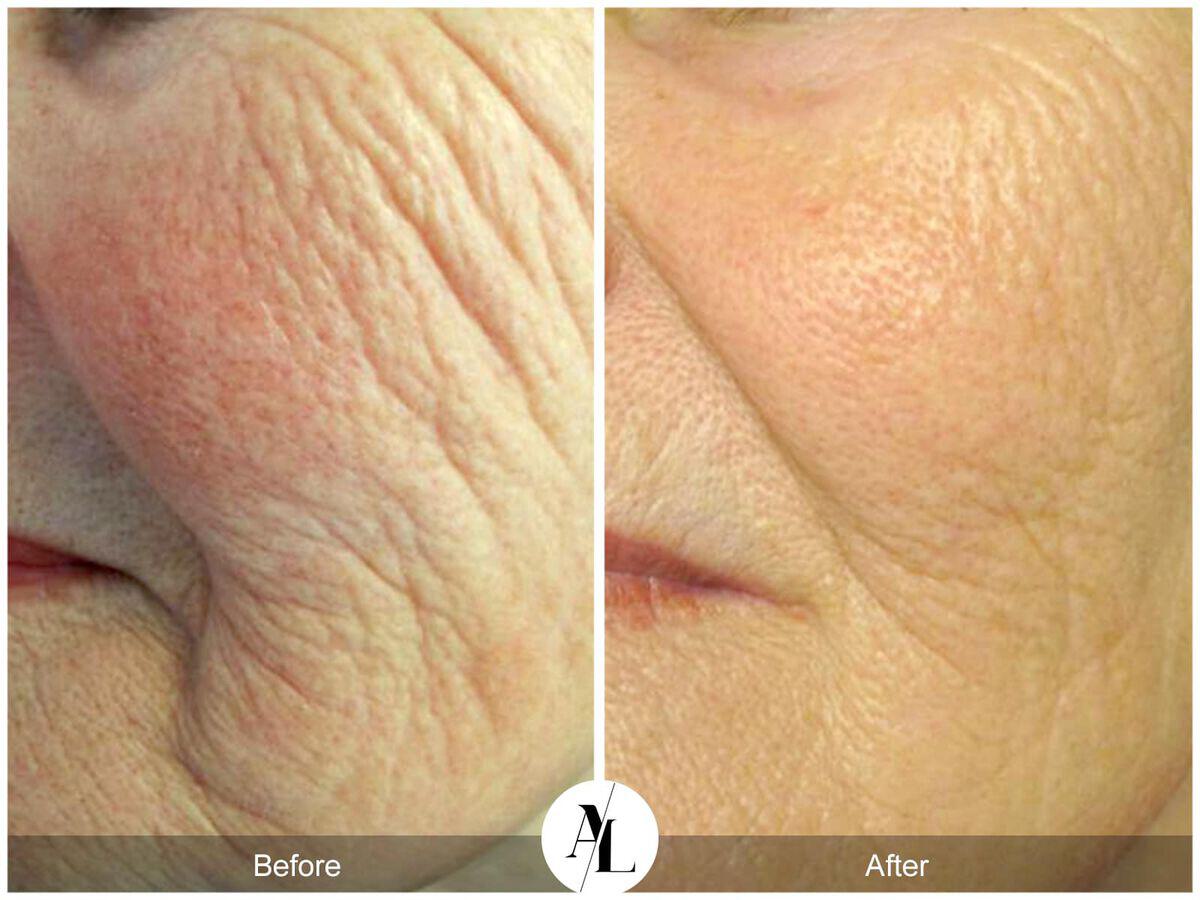 Skin Tightening Before & After Photo