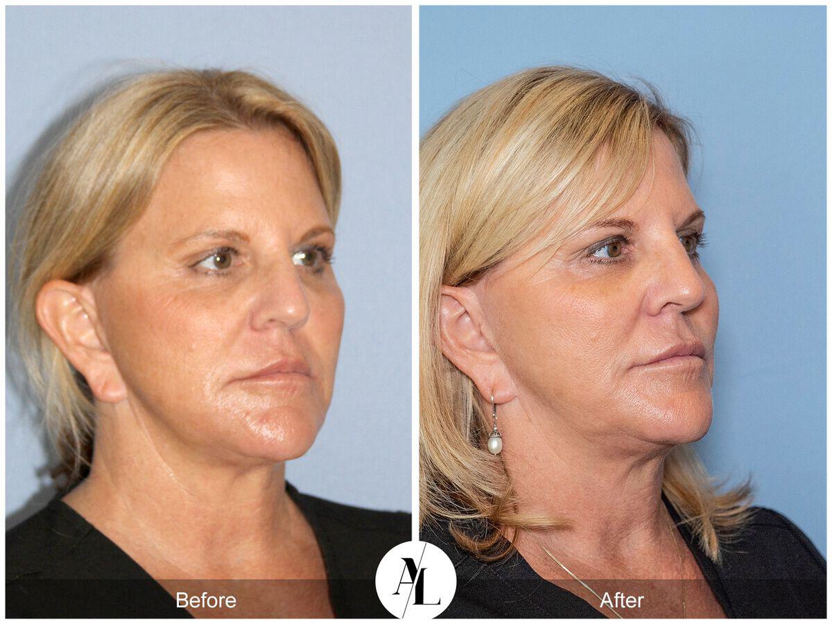 Skin Tightening Before & After Photo