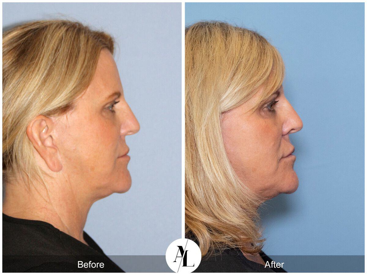 Skin Tightening Before & After Photo