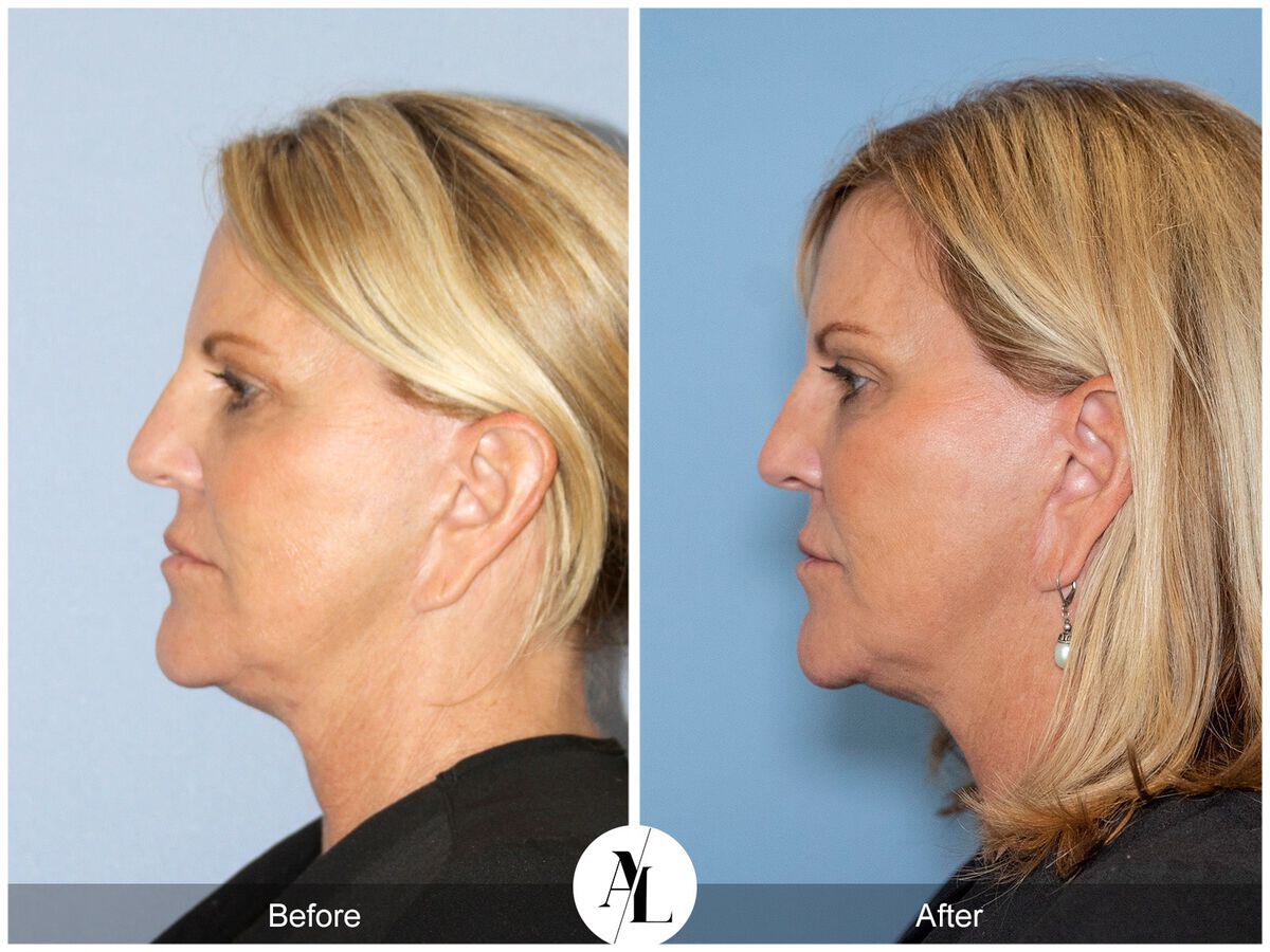 Skin Tightening Before & After Photo