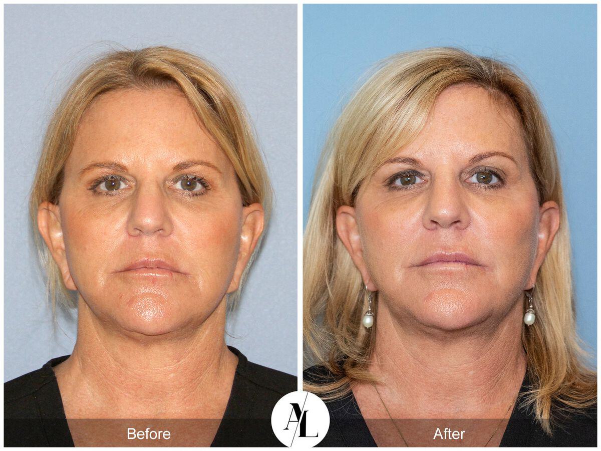 Skin Tightening Before & After Photo