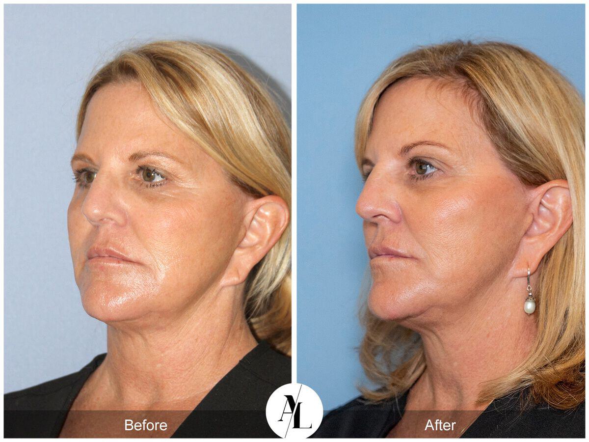 Skin Tightening Before & After Photo