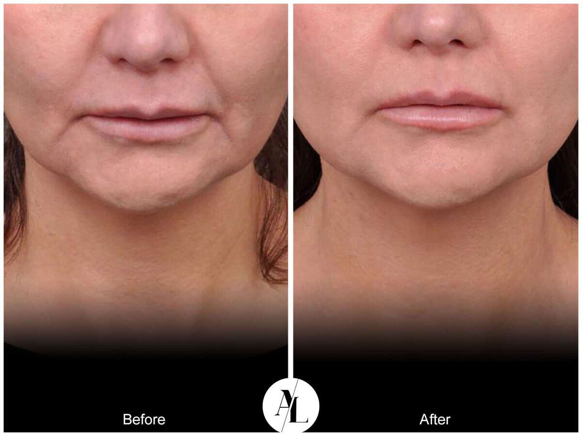 Skin Tightening Before & After Photo