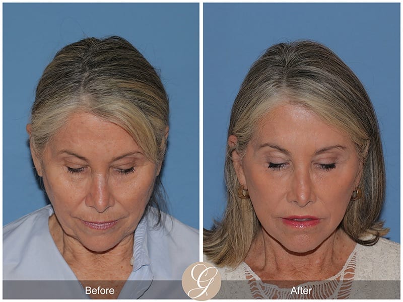 Deep Plane Facelifts Before & After Photo