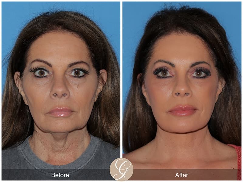 Deep Plane Facelifts Before & After Photo