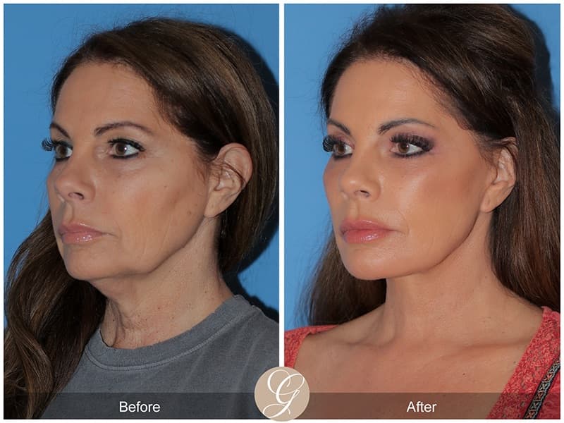 Deep Plane Facelifts Before & After Photo