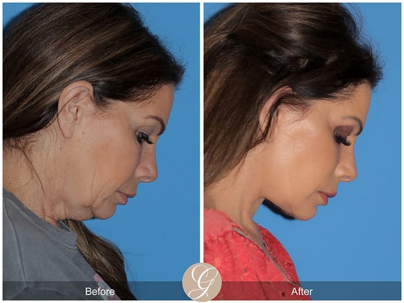 Deep Plane Facelifts Before & After Photo