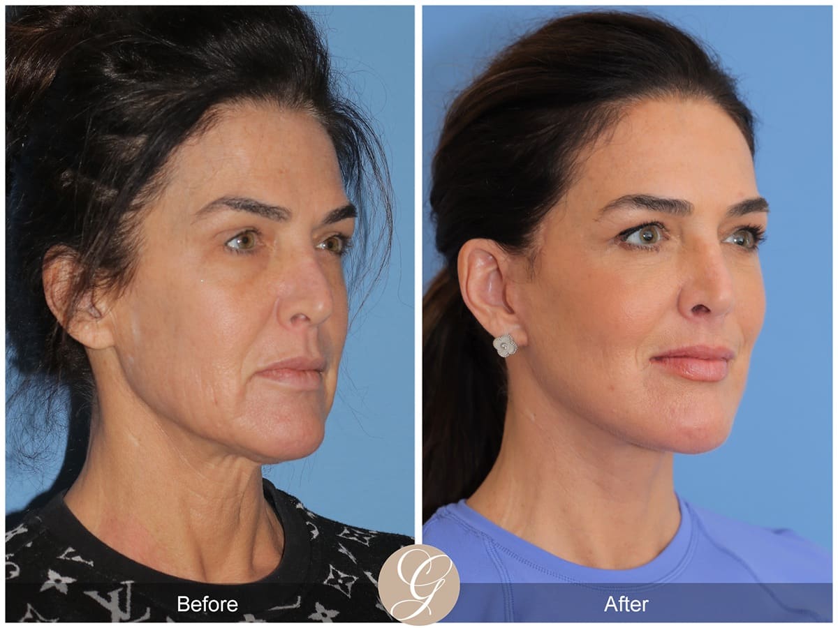 Deep Plane Facelifts Before & After Photo