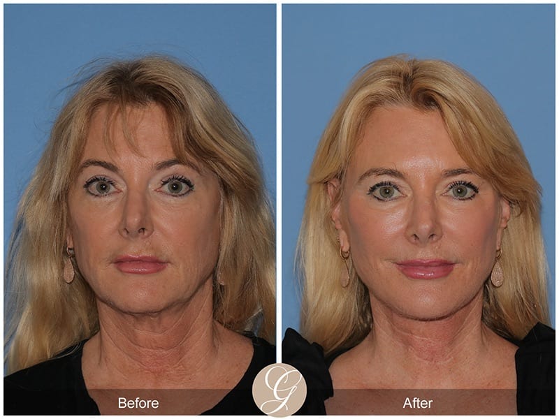 Deep Plane Facelifts Before & After Photo