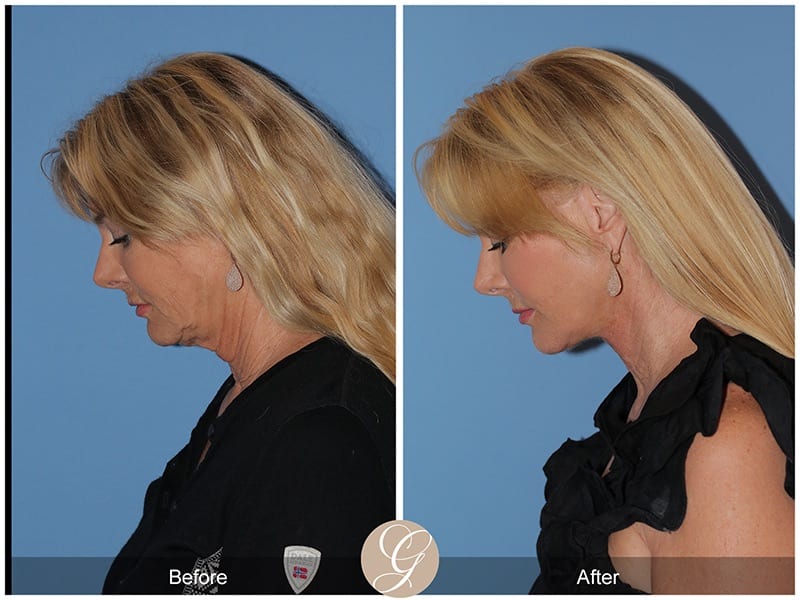 Deep Plane Facelifts Before & After Photo