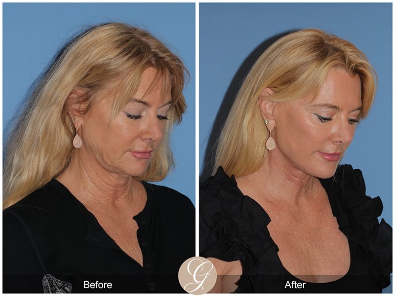 Deep Plane Facelifts Before & After Photo