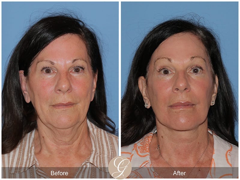 Deep Plane Facelifts Before & After Photo