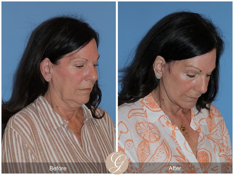 Deep Plane Facelifts Before & After Photo