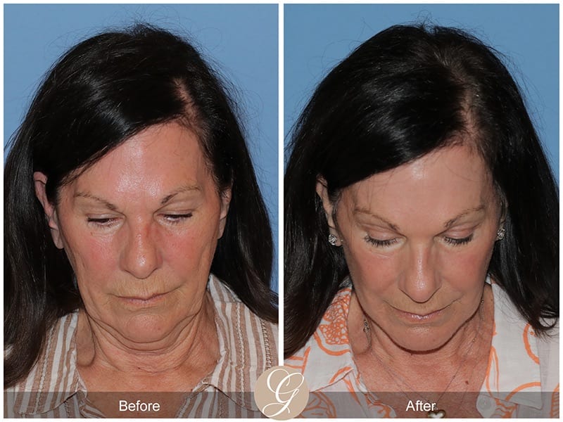 Deep Plane Facelifts Before & After Photo