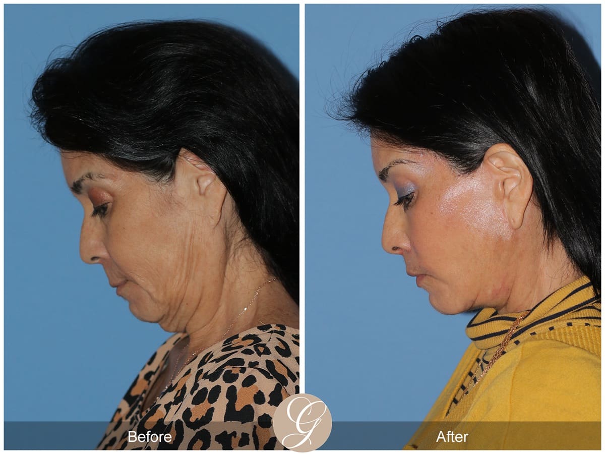 Deep Plane Facelifts Before & After Photo