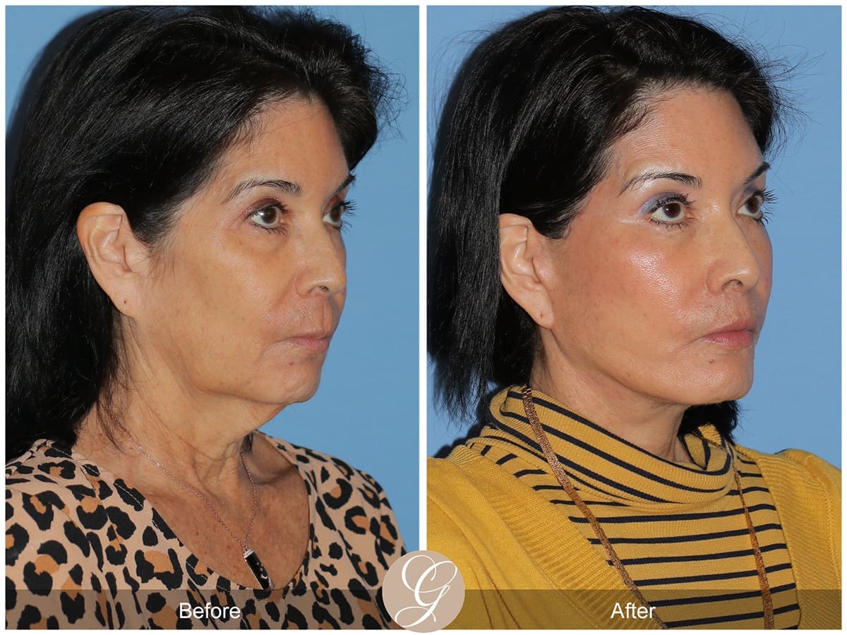 Deep Plane Facelifts Before & After Photo