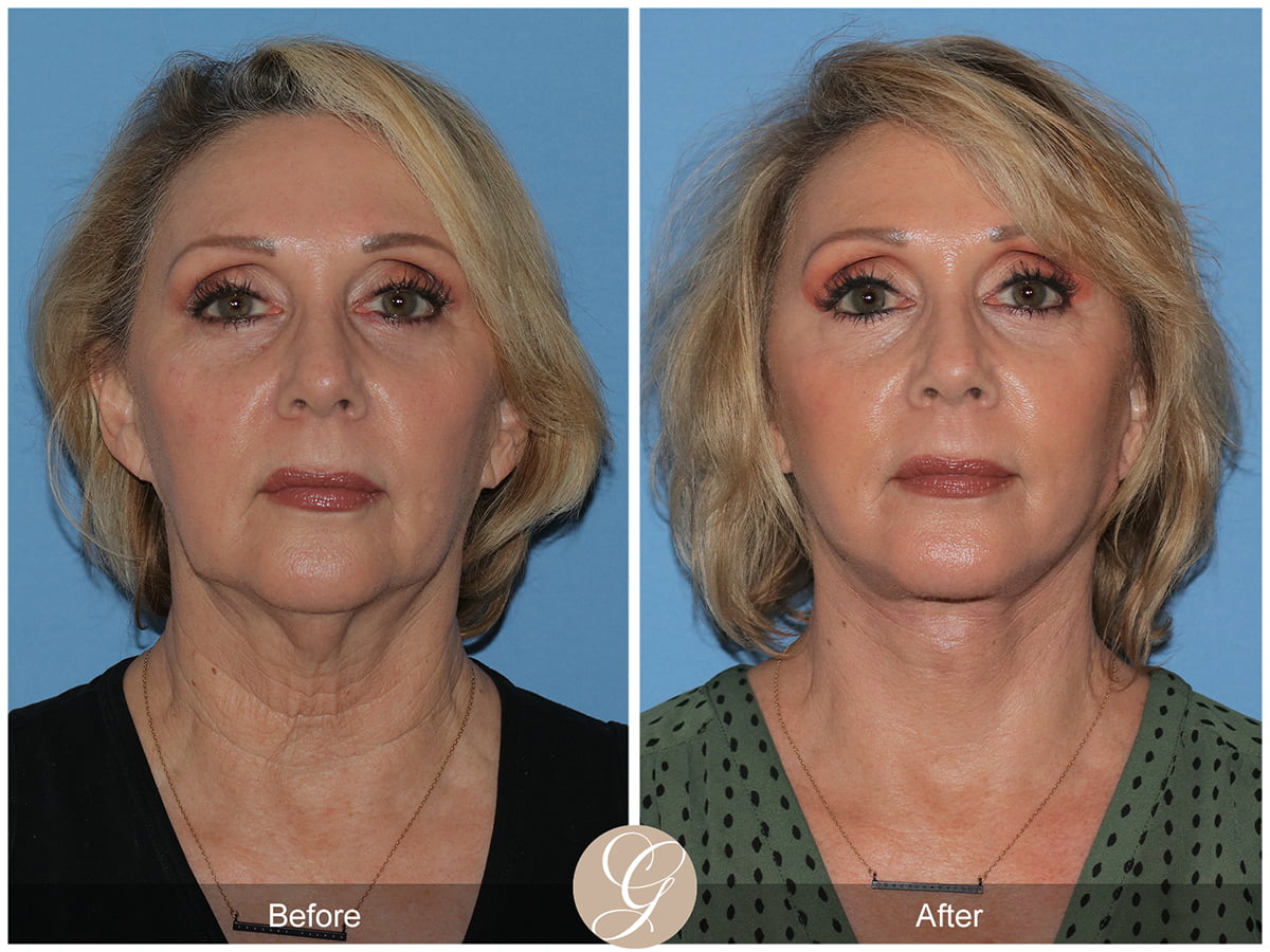 Deep Plane Facelifts Before & After Photo