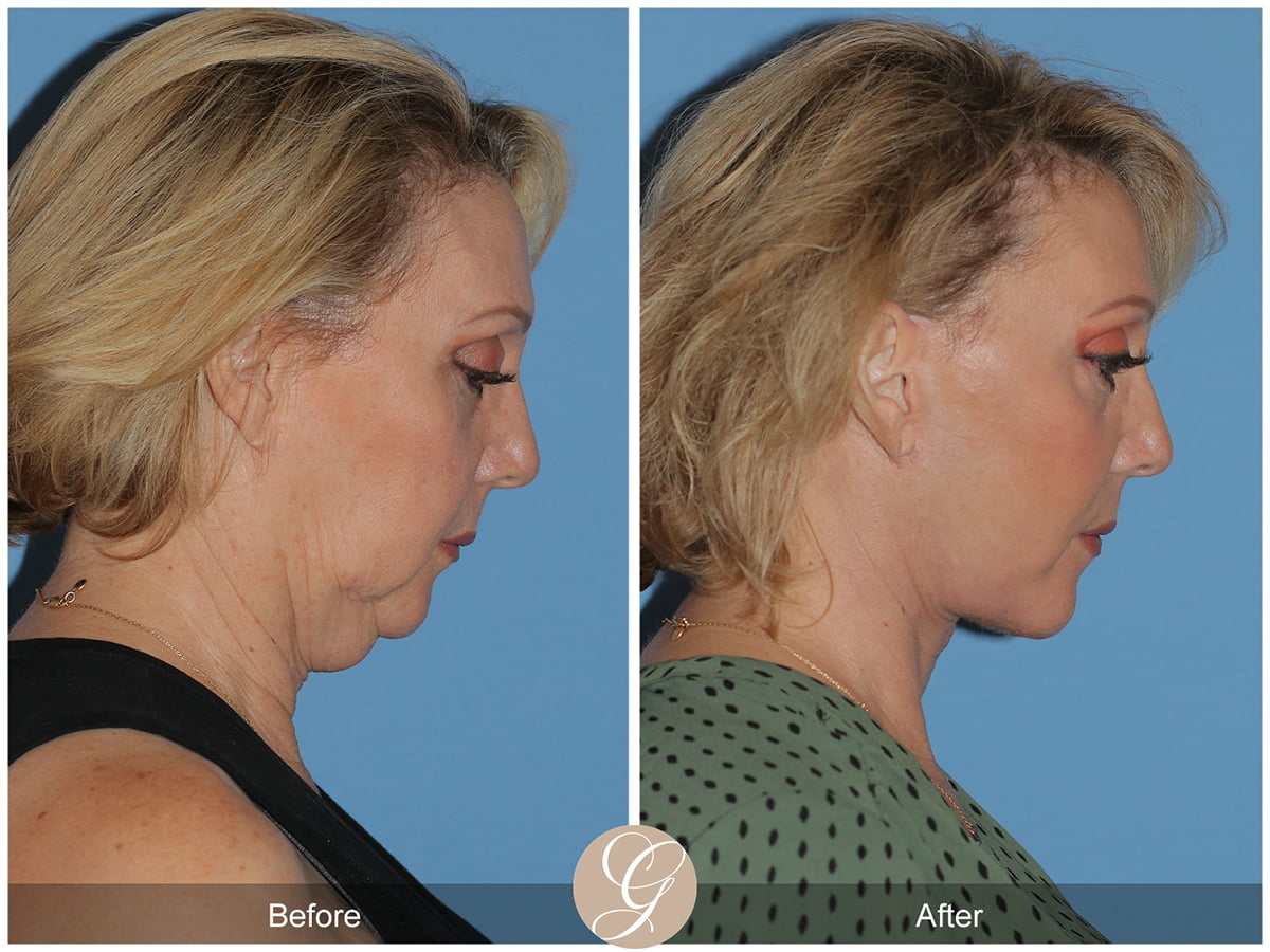 Deep Plane Facelifts Before & After Photo