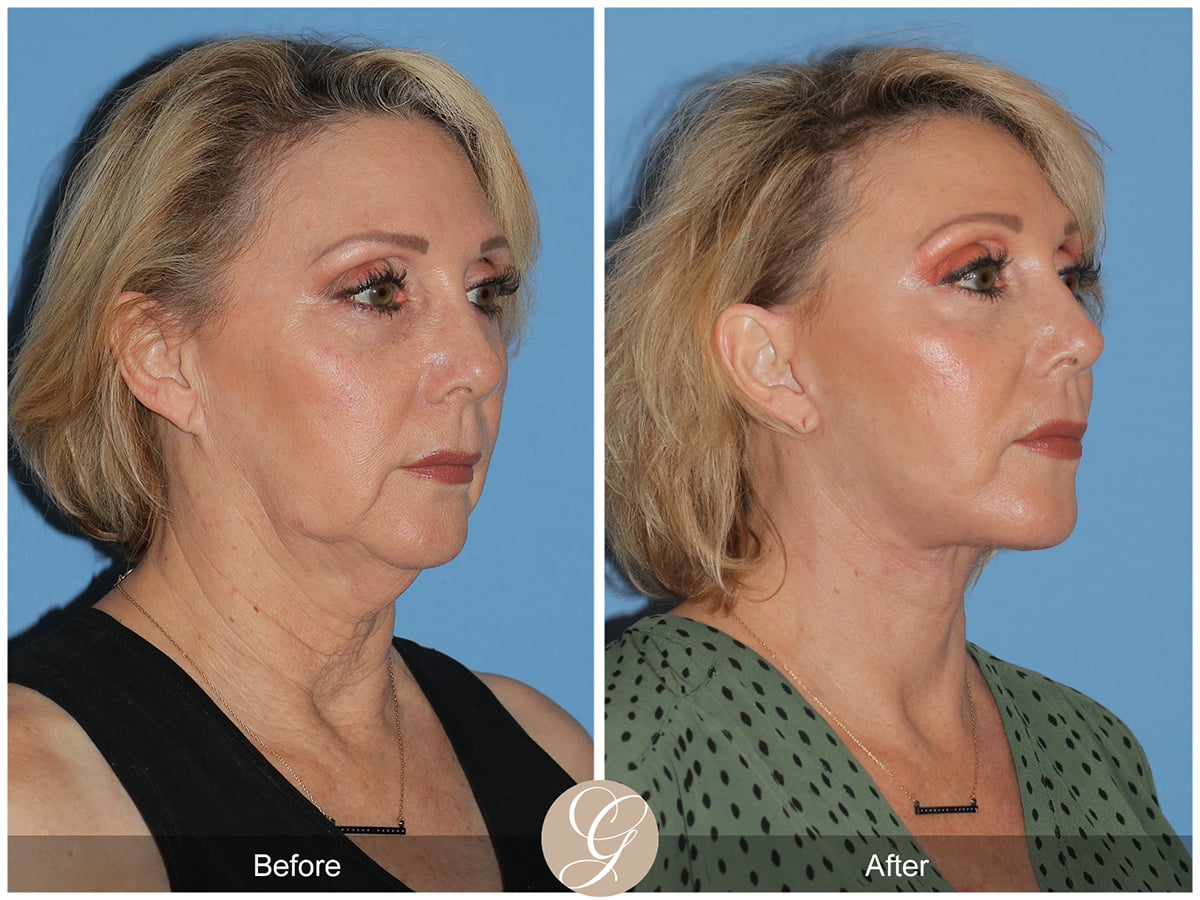 Deep Plane Facelifts Before & After Photo