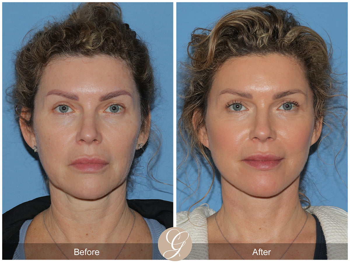 Deep Plane Facelifts Before & After Photo