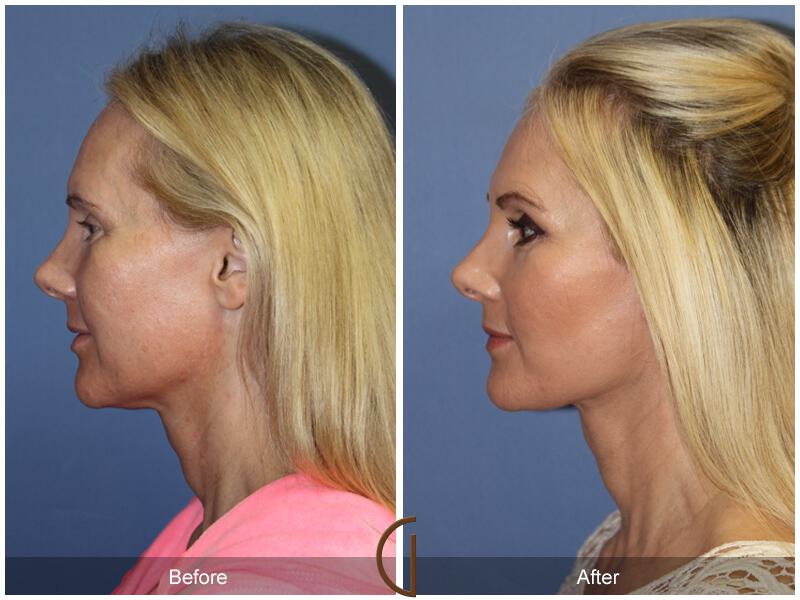 Facelift Forties Before & After Photo