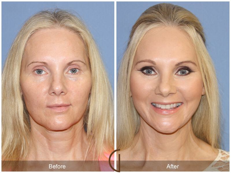 Facelift Forties Before & After Photo