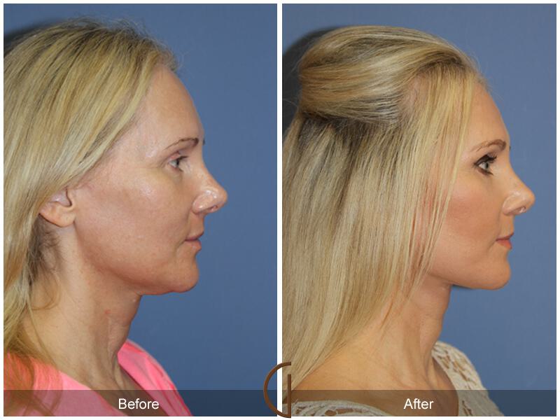 Facelift Forties Before & After Photo