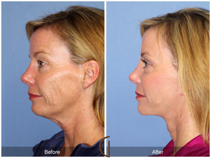 Facelift Forties Before & After Photo