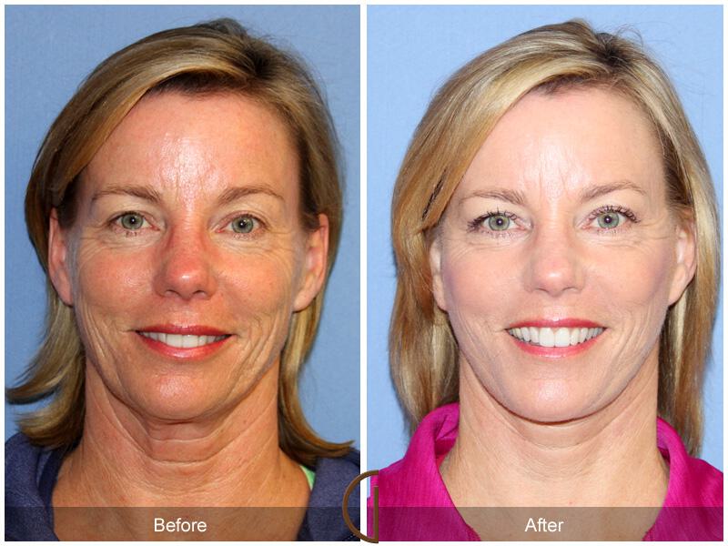 Facelift Forties Before & After Photo