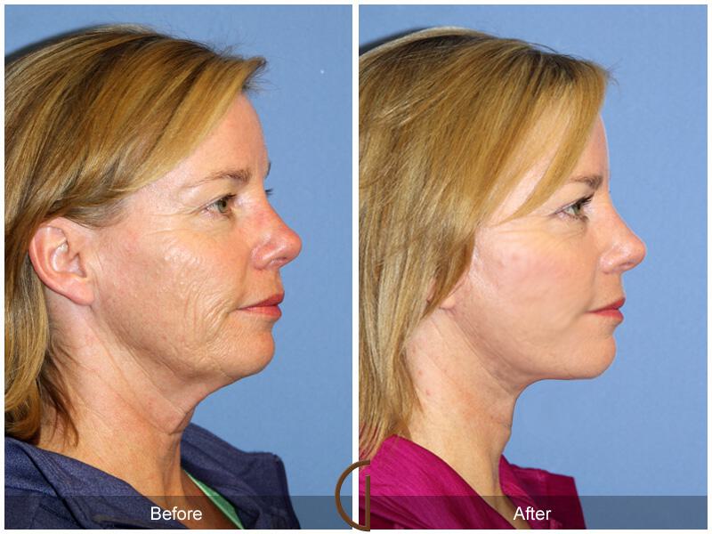 Facelift Forties Before & After Photo