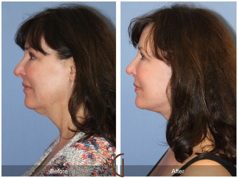 Facelift Forties Before & After Photo