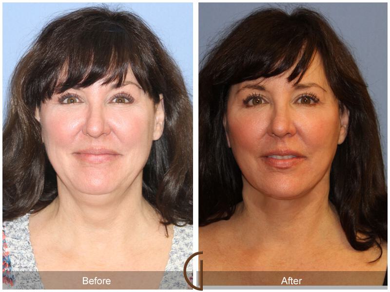 Facelift Forties Before & After Photo