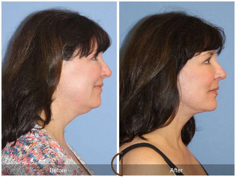 Facelift Forties Before & After Photo