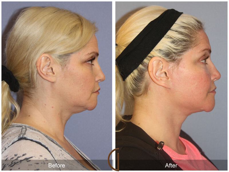 Facelift Forties Before & After Photo