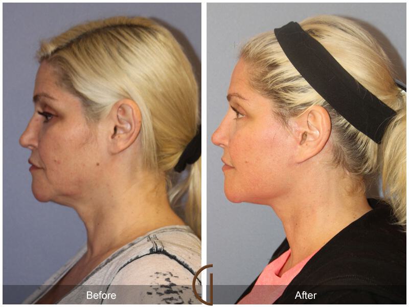 Facelift Forties Before & After Photo