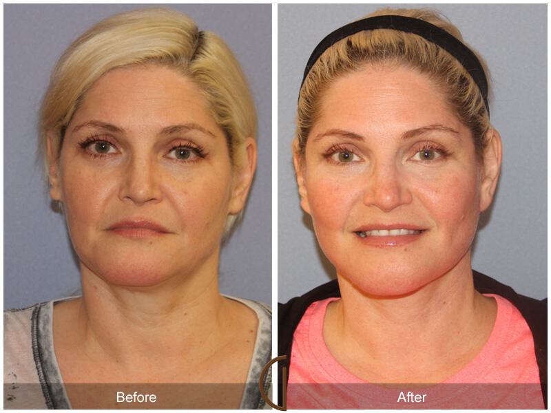 Facelift Forties Before & After Photo