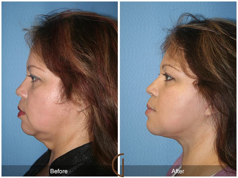 Facelift Forties Before & After Photo