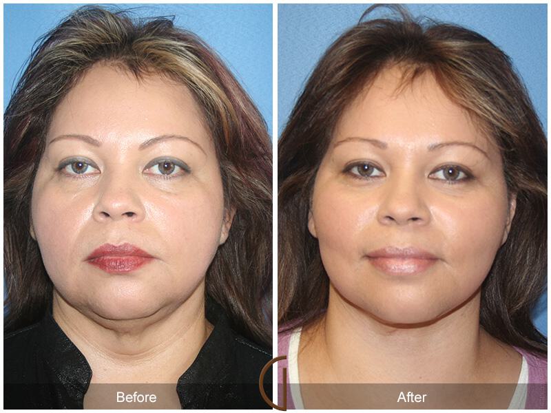 Facelift Forties Before & After Photo