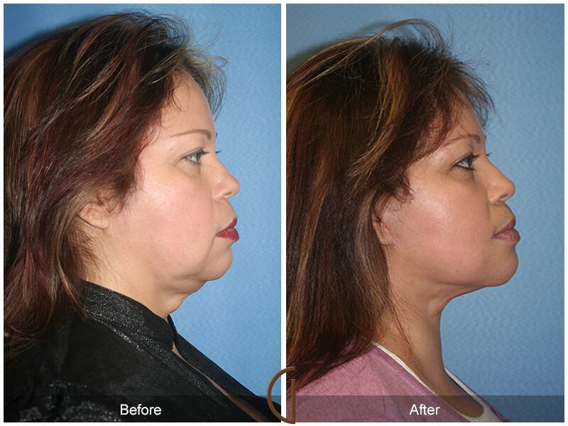 Facelift Forties Before & After Photo