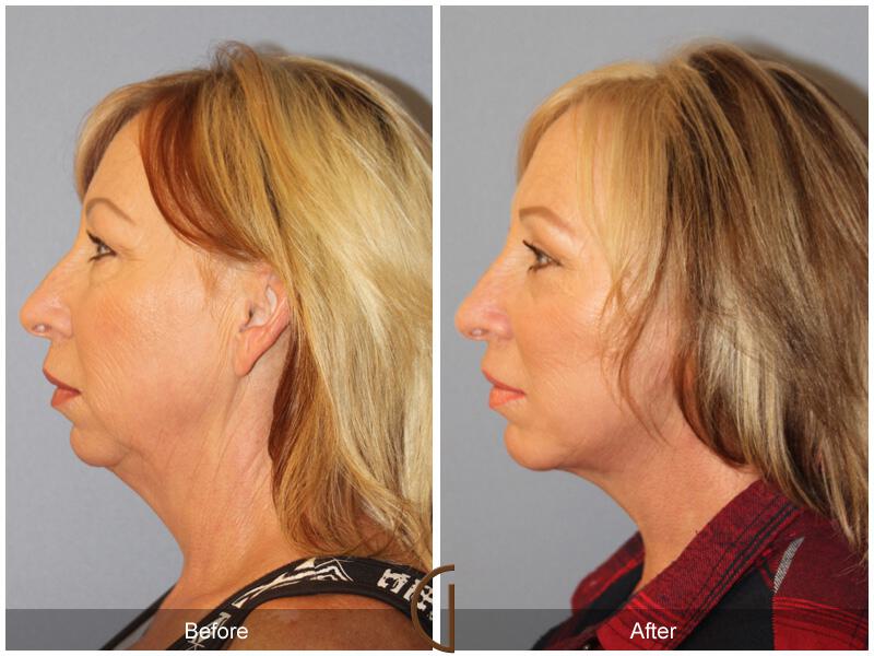 Facelift Forties Before & After Photo